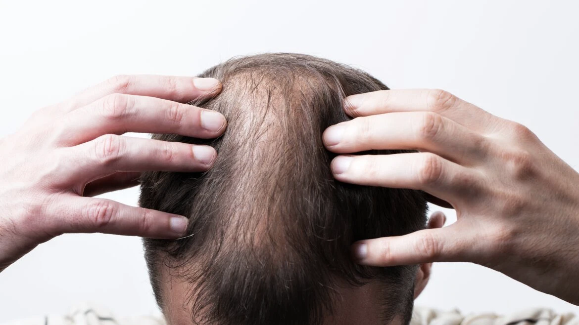 Hair loss problem
